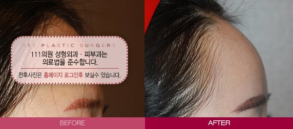 턱선 종결자 피코팻 전후사진