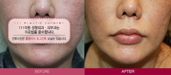 v라인 만들기 전후사진