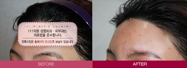 이마큐오필 전후사진