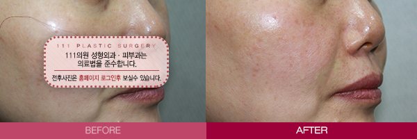 팔자필러 전후사진