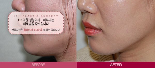 턱선 종결자 비너스레이저 전후사진