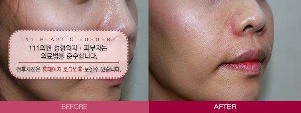 팔자필러 전후사진