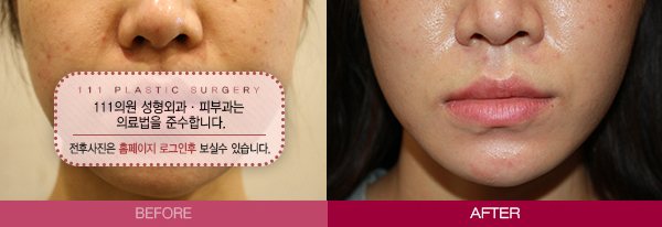 팔자필러 전후사진