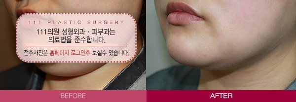 턱선 종결자 전후사진