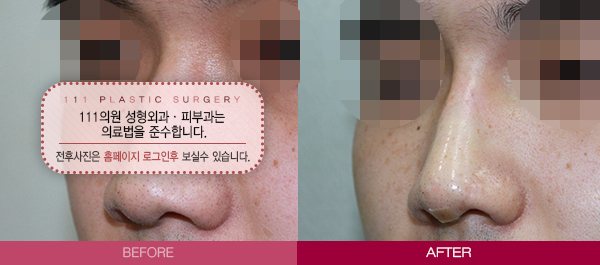 코성형은 역시 111 전후사진