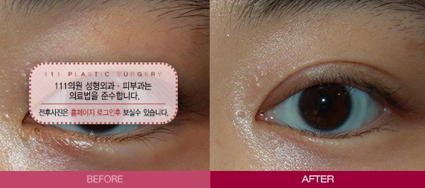 상안검은 111 전후사진