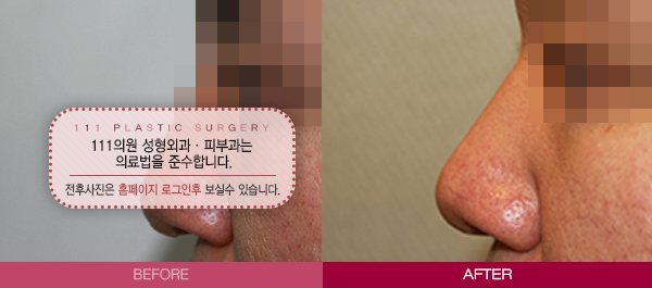 남자 콧대 올리기 전후사진