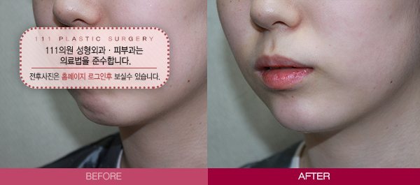 무턱필러 전후사진
