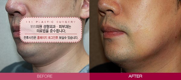 나만의턱선 살리기 전후사진