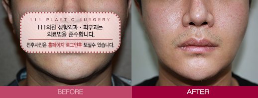 피코팻 전후사진