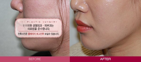 턱살 전후사진