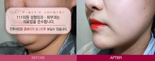 턱살 전후사진